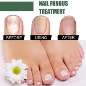 Fast Nail Fungus Treatment Serum | Nail Repair Essence for Fingernails & Toenails | Natural Nail Care Formula