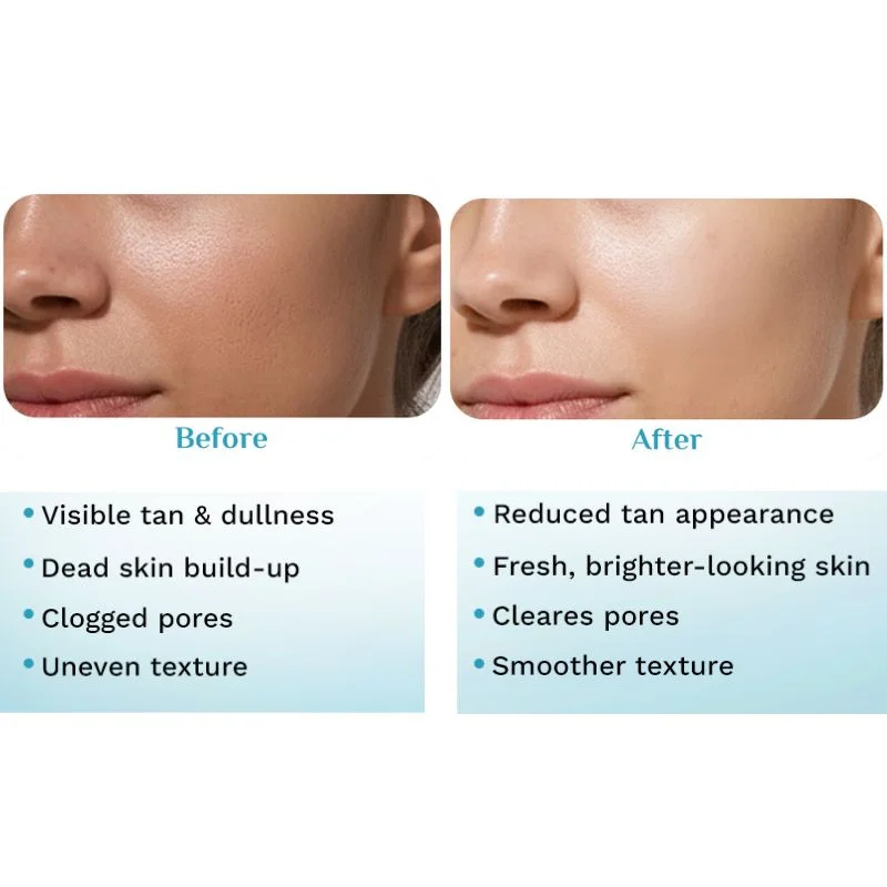 Pilgrim Peeling Solution | Weekend Facial Peel for Deep Cleansing & Exfoliation | Radiant & Even-Toned Skin | For Men & Women | 30ml - Image 7